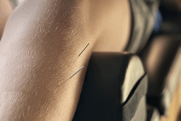 Dry needling in Missoula at Electric Rehab & Fitness relieving muscle tension and pain