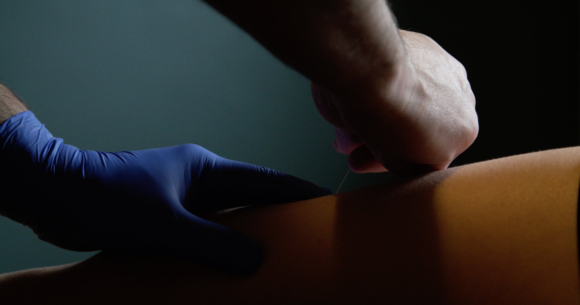 Gloved hands placing a dry needle in a patient's leg