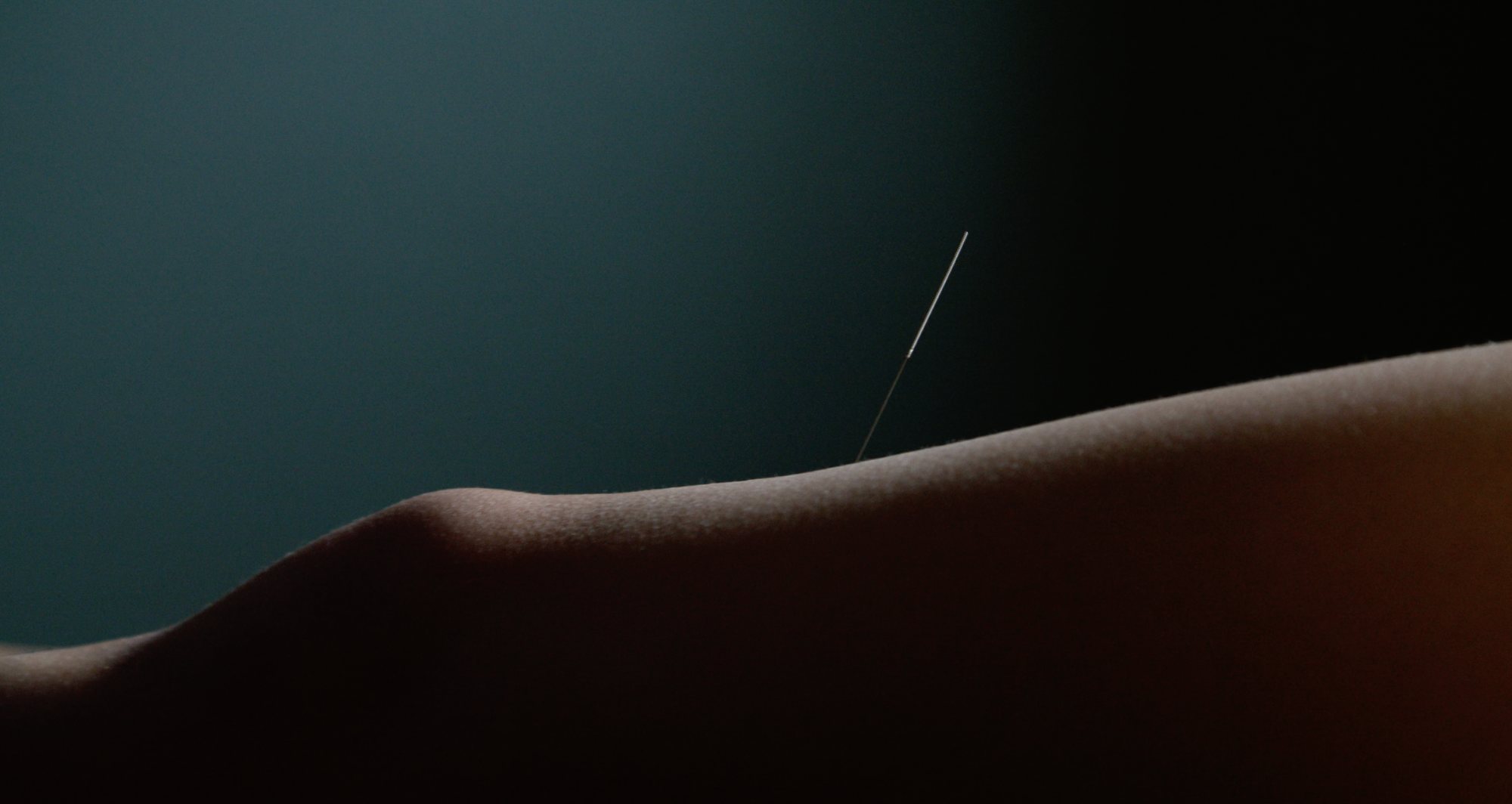 A single dry needle in a patient's thigh