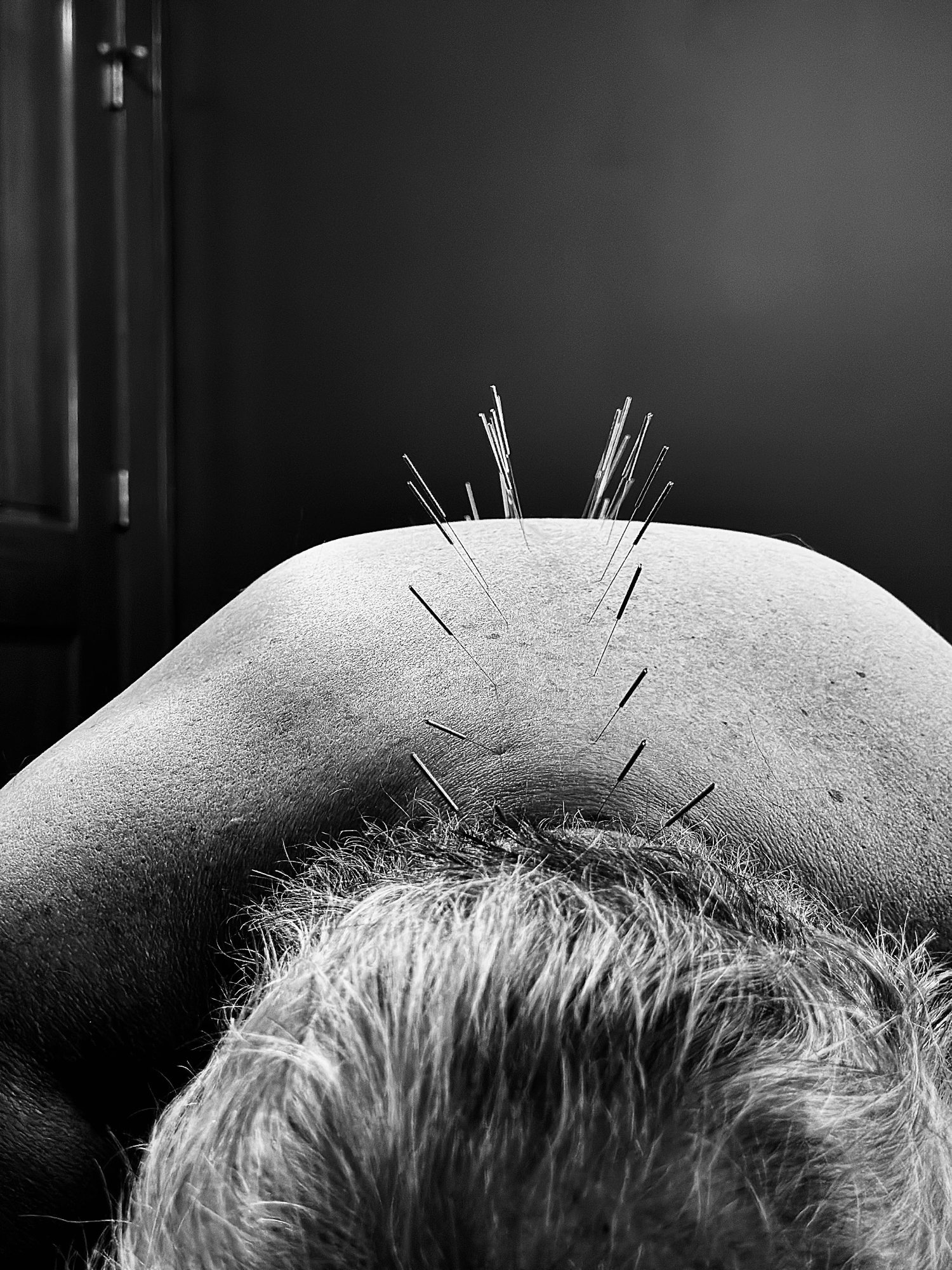 Dozens of dry needles placed across a patient's upper back and neck
