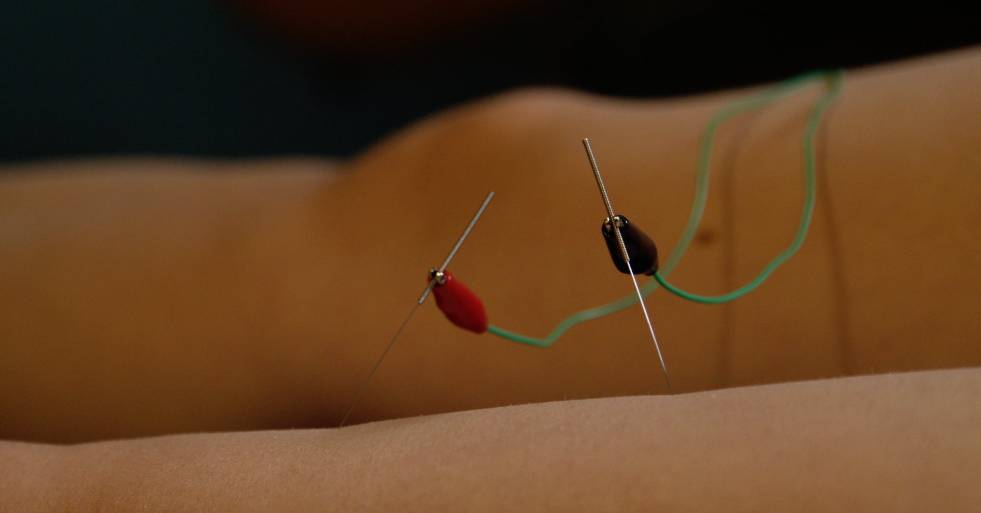 Two dry needles connected to electrical stimulation leads during electro dry needling in Missoula