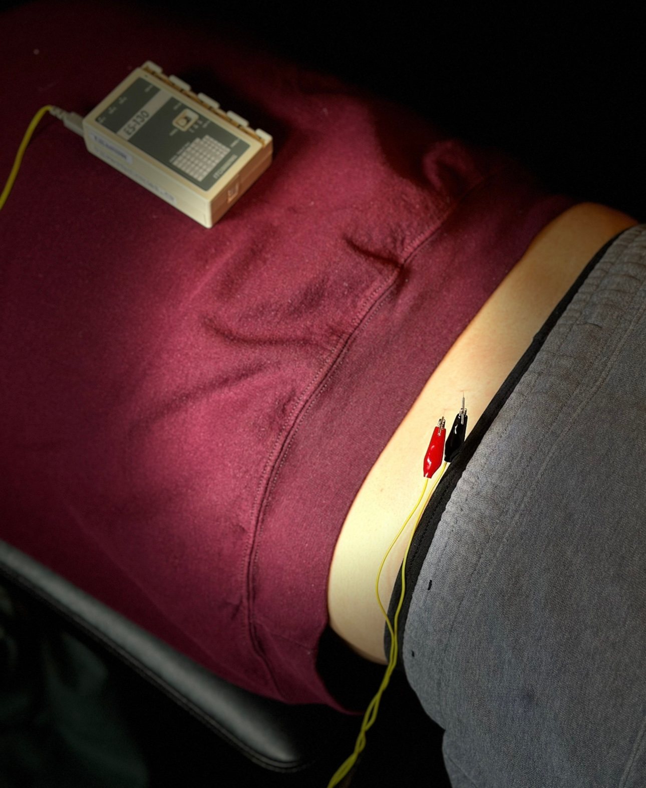 Electro dry needling on a patient's lower back with the stimulation unit attached